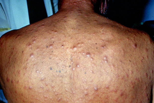 a person’s back with nodular acne bumps