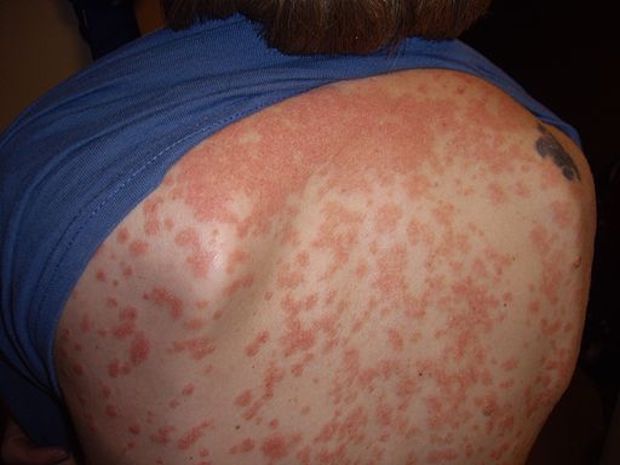 psoriasis rash on a person’s back